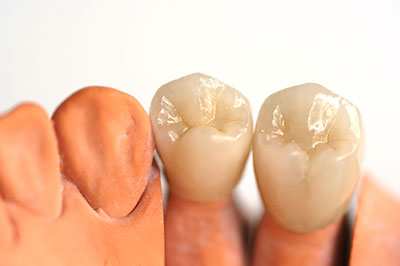 Cameron Park Dental Care | Ceramic Crowns, Dentures and CEREC