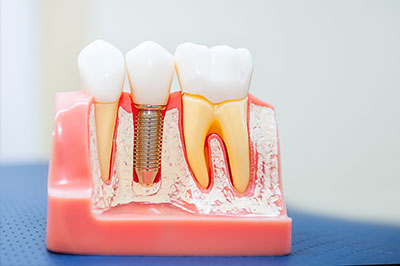 Cameron Park Dental Care | Periodontal Treatment, Air Abrasion and Root Canals