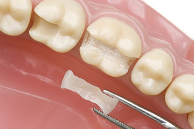 Cameron Park Dental Care | Veneers, Inlays  amp  Onlays and Night Guards