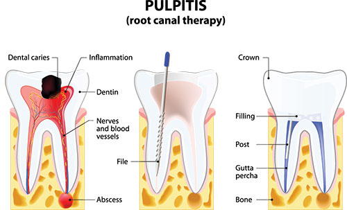 Cameron Park Dental Care | Implant Dentistry, Sports Mouthguards and Fluoride Treatment