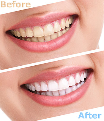 Cameron Park Dental Care | Teeth Whitening, Dental Cleanings and All-on-4 reg 